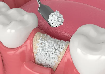 Bone Grafting Image