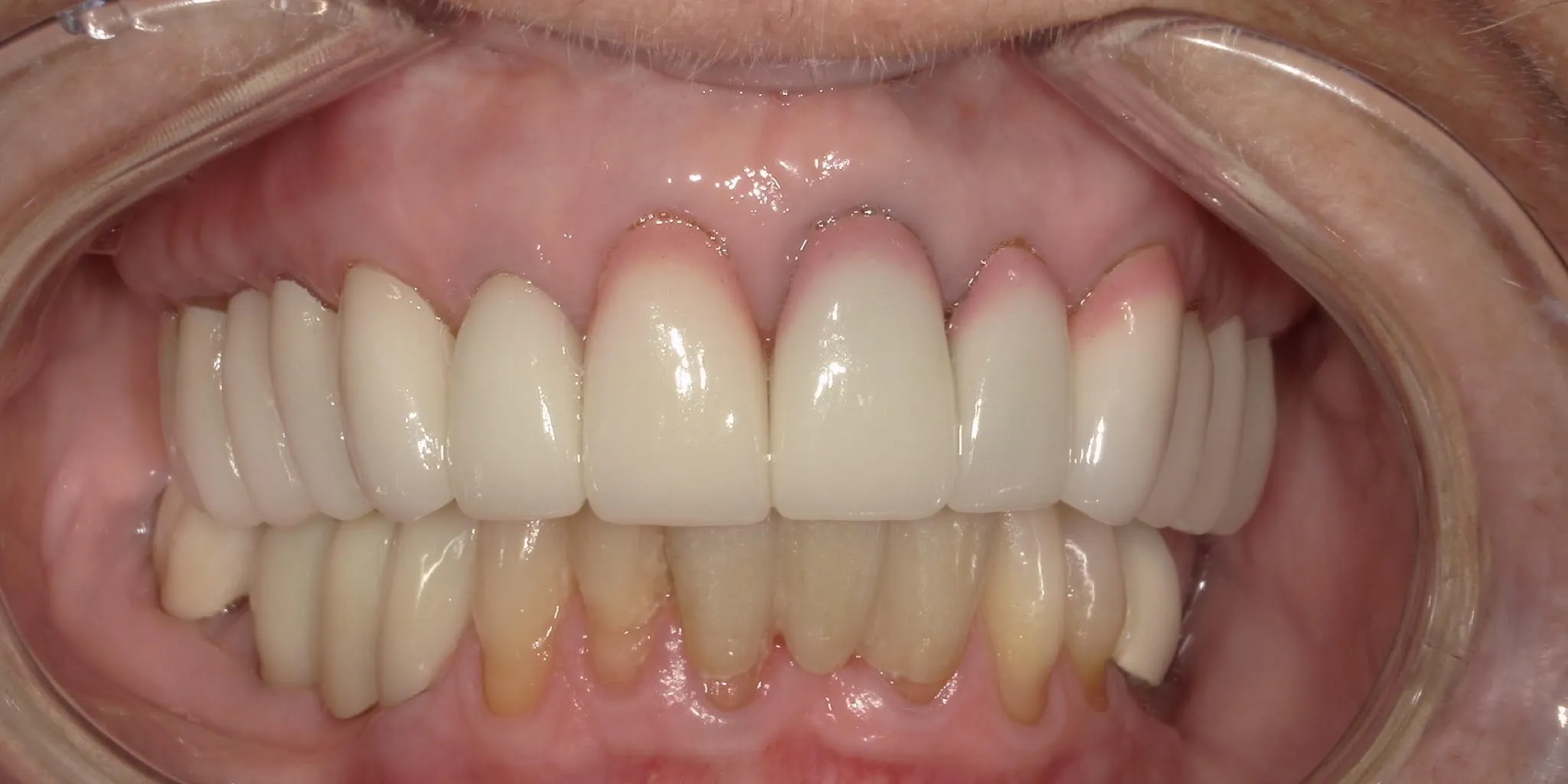 Full Mouth Rehab After