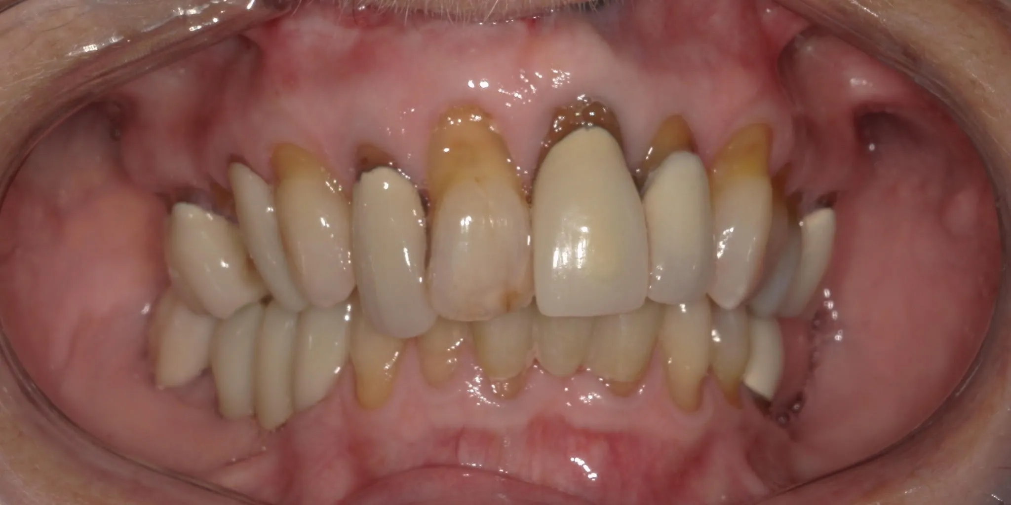 Full Mouth Rehab Before