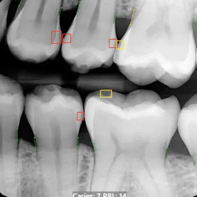 Dental X-Rays