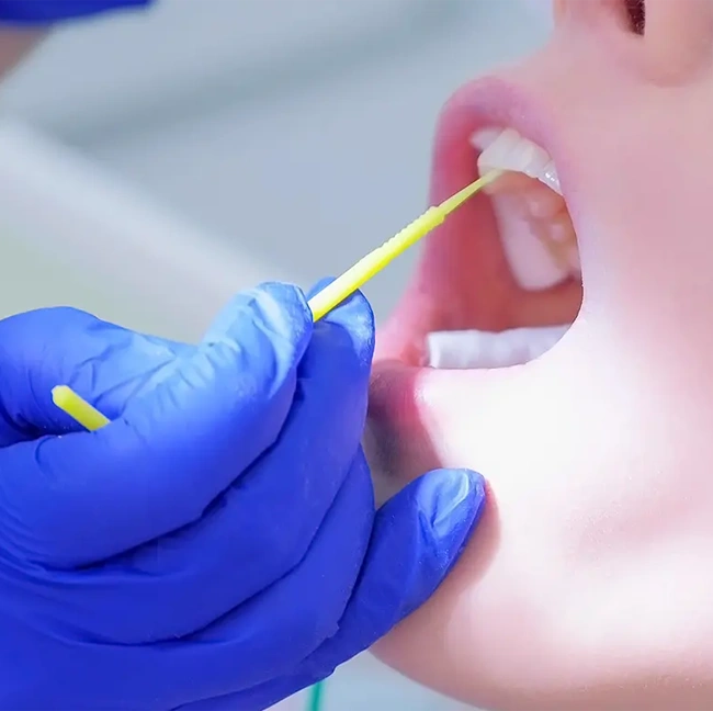 Fluoride Treatments Image