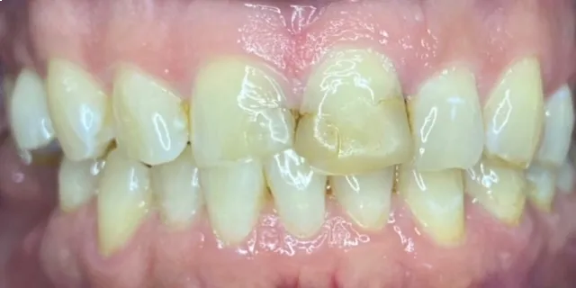 Full Mouth Rehab Before