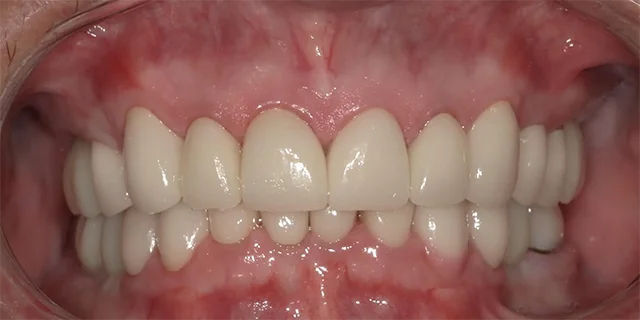 Full Mouth Rehab After