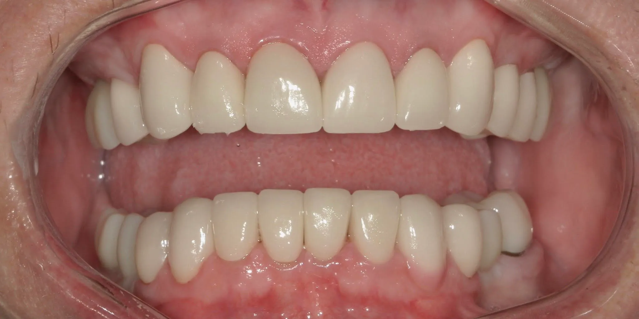 Full Mouth Rehab After