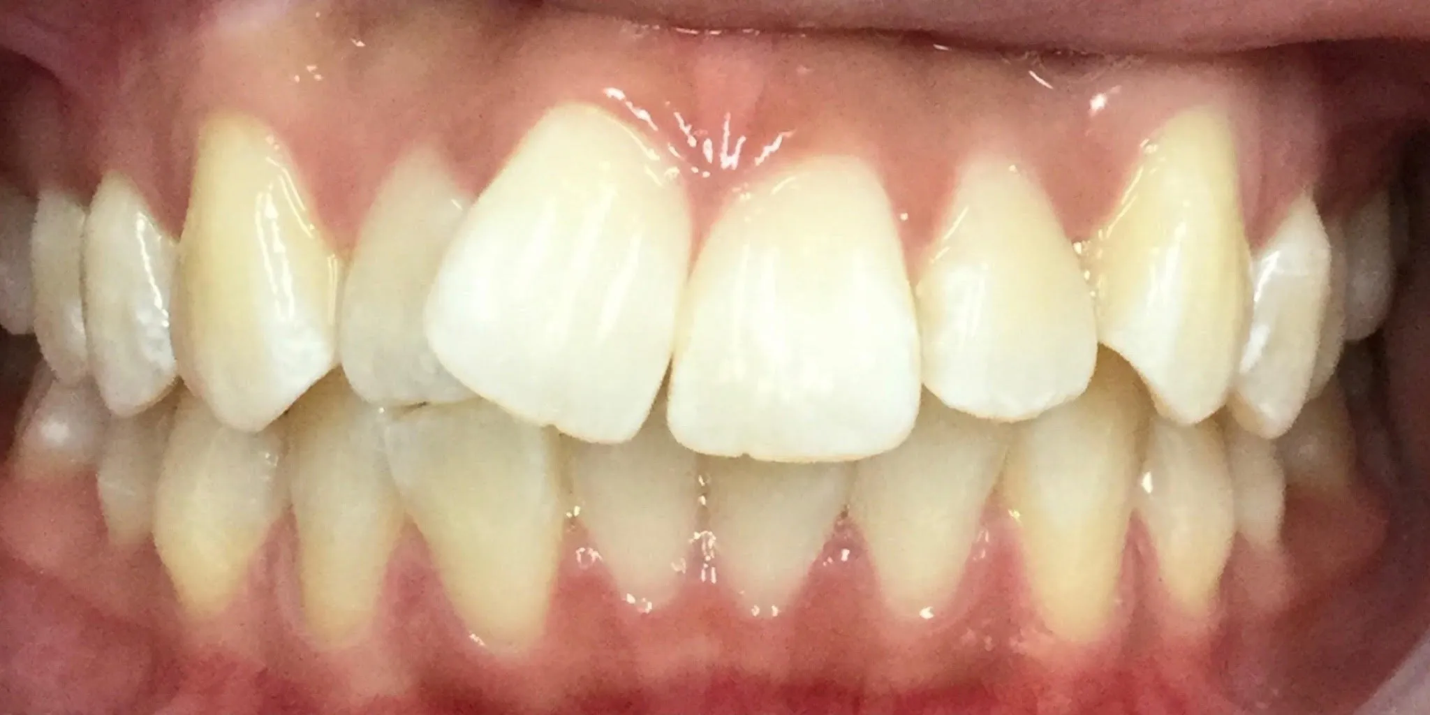 Full Mouth Rehab Before