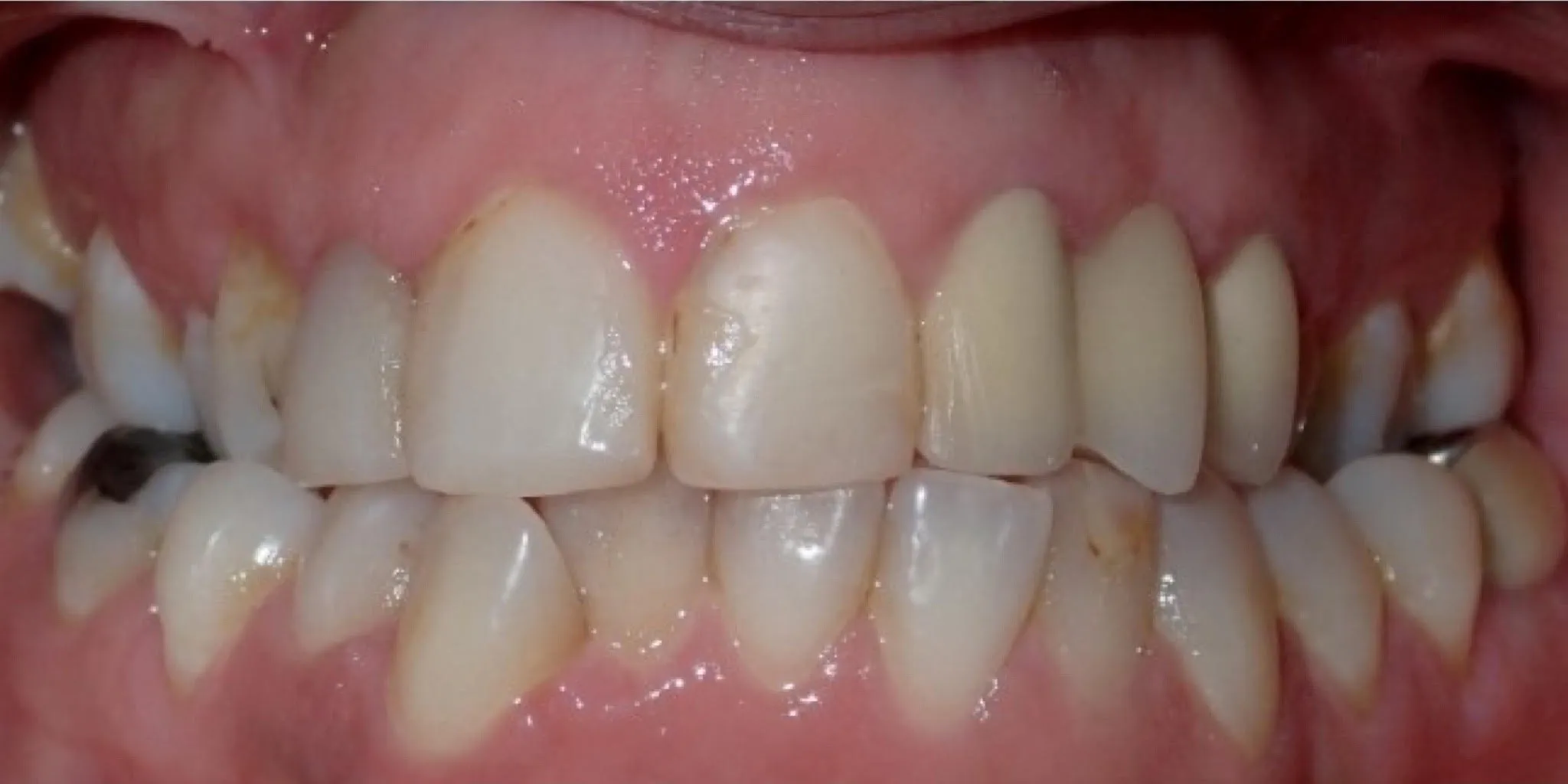 Full Mouth Rehab Before