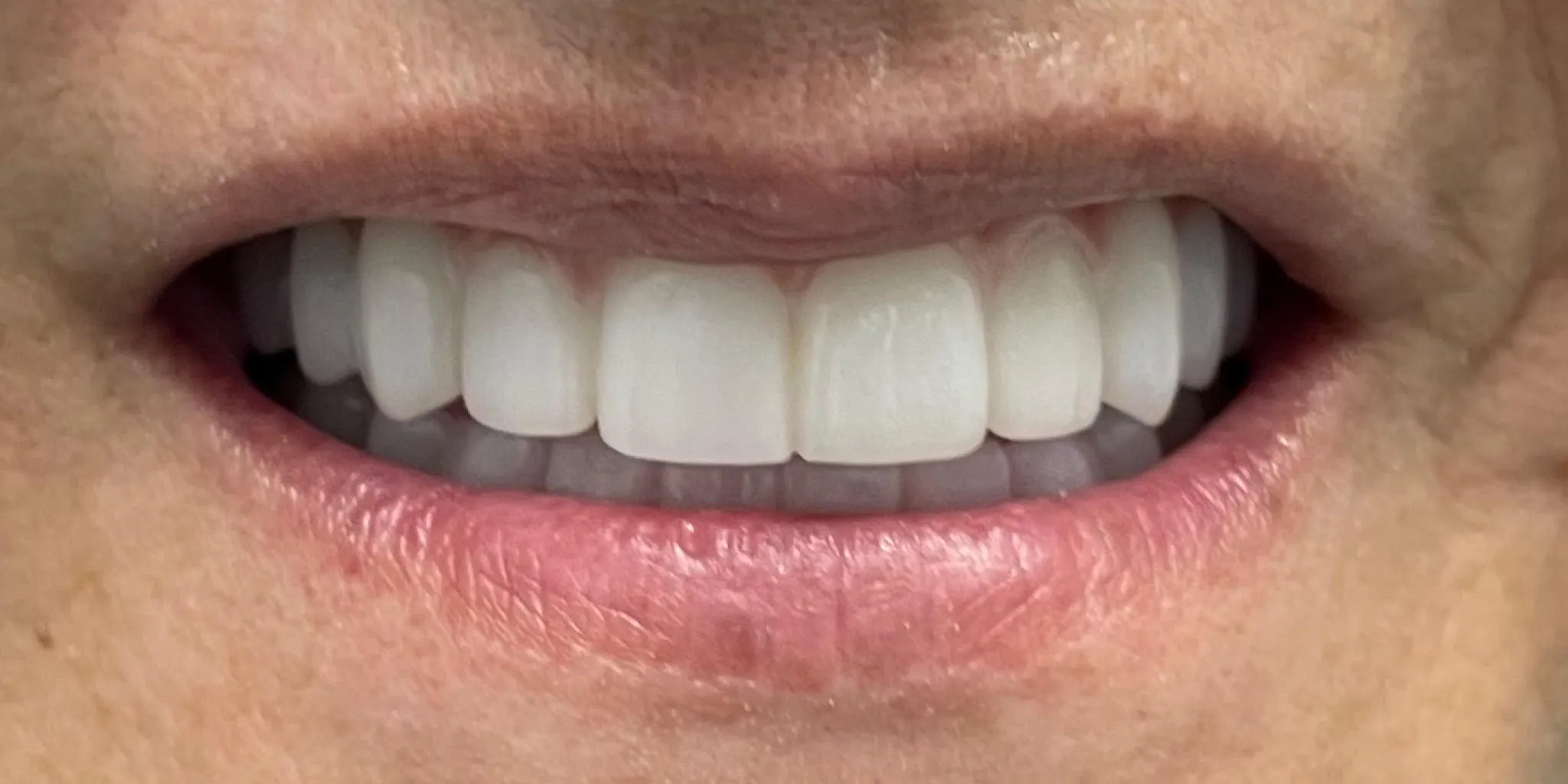 Full Mouth Rehab After