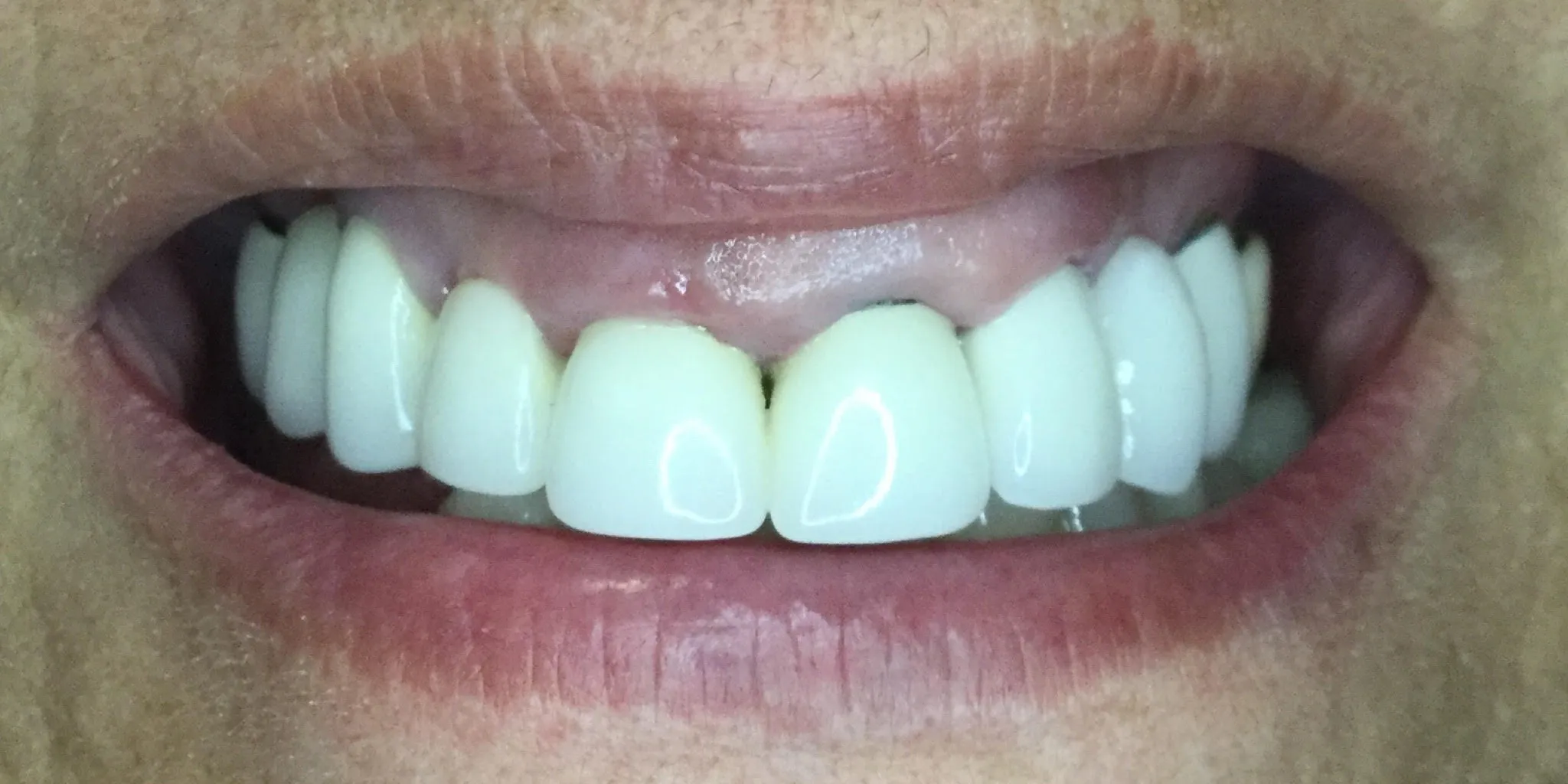 Full Mouth Rehab Before