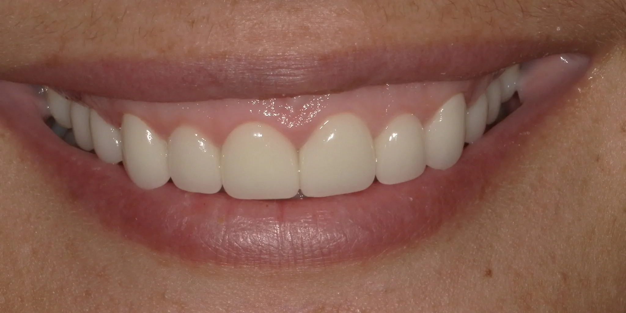 Full Mouth Rehab After