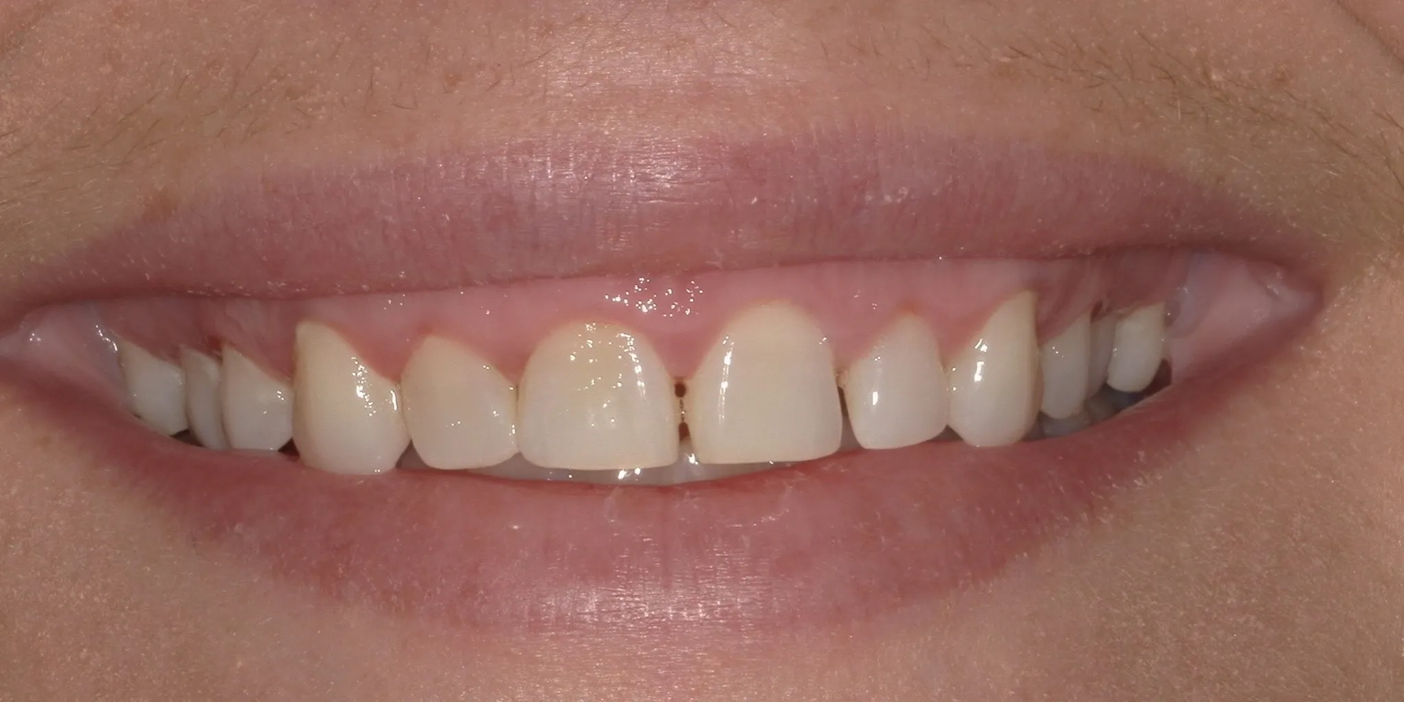 Full Mouth Rehab Before