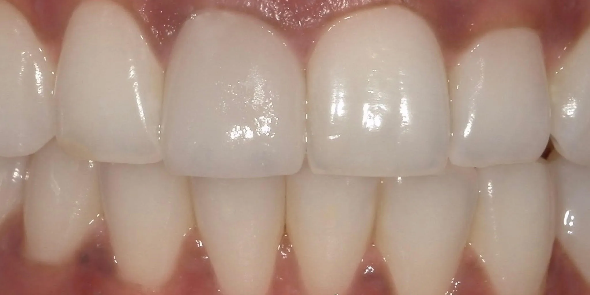 Full Mouth Rehab After