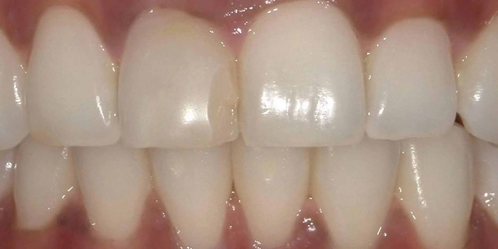 Full Mouth Rehab Before