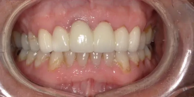 Full Mouth Rehab After