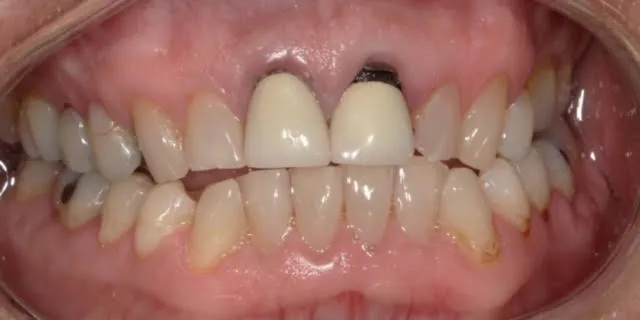 Full Mouth Rehab Before