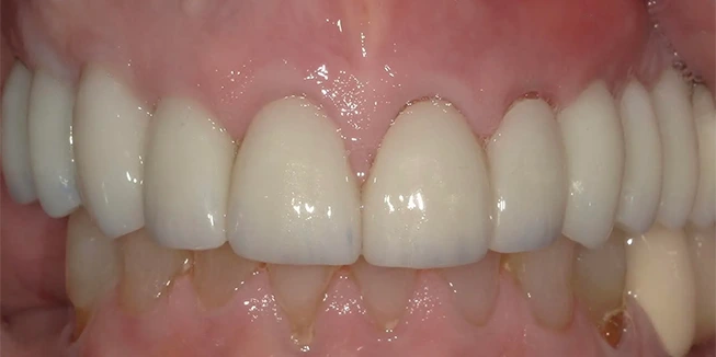 Full Mouth Rehab After