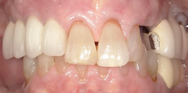 Full Mouth Rehab Before